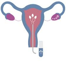 IUI Treatment